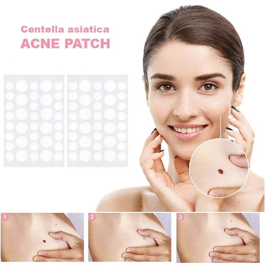 Hydrocolloid Acne Pimple Patch for Covering Zits and Blemishes, Spot Stickers for Face and Skin (144 Count)